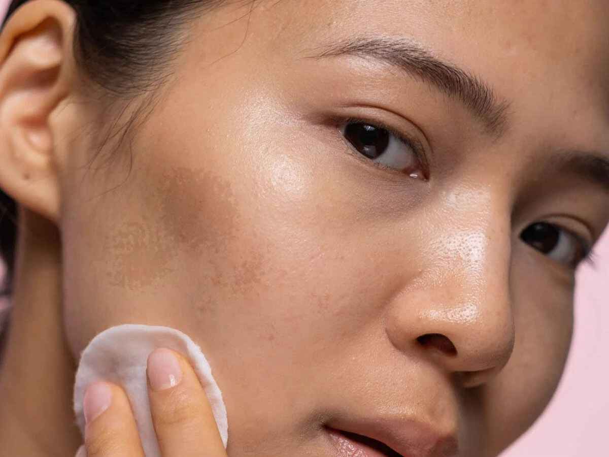 Consultation for Hyperpigmentation