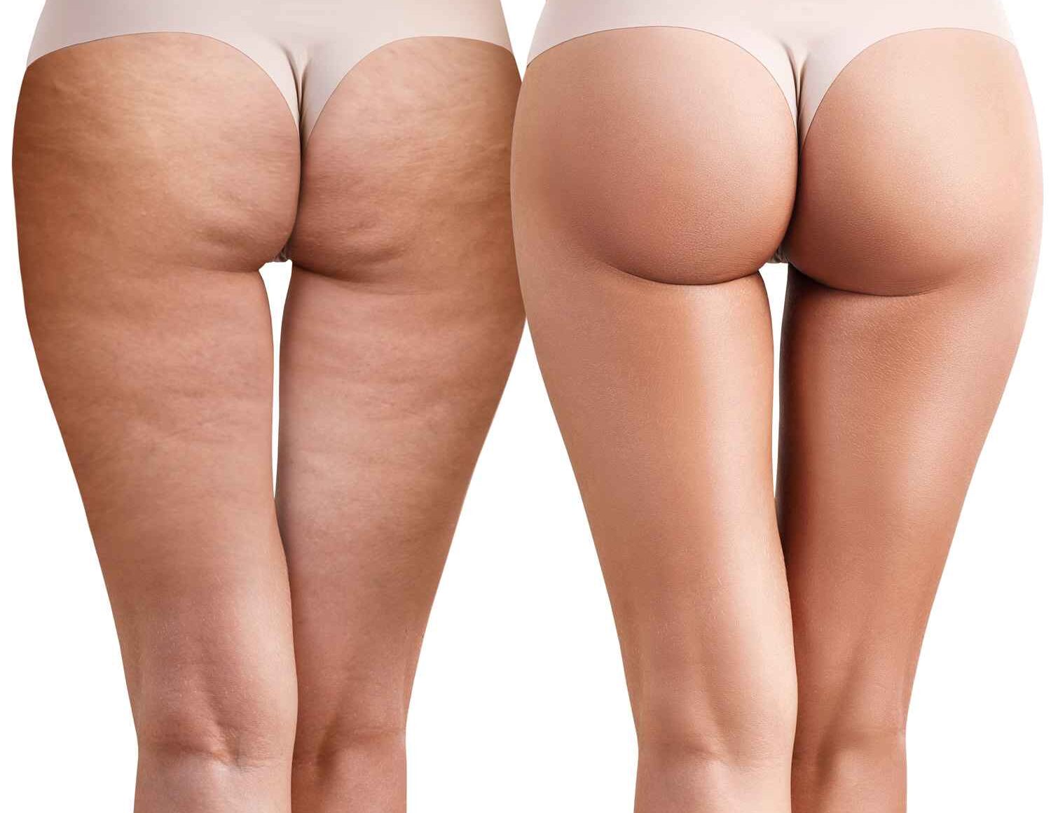 Consultation for Cellulite Treatments