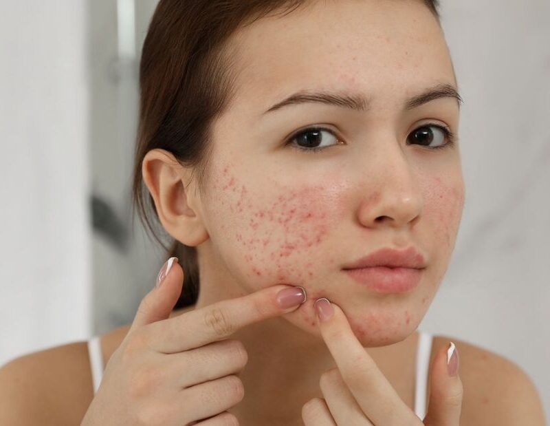 Consultation for Acne Treatments